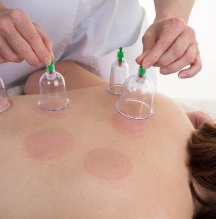 cupping