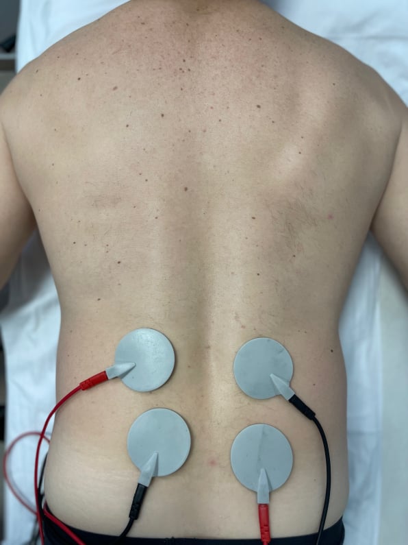 Ηλεκτροθεραπεία